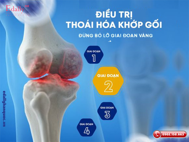 Cách nhận biết 4 giai đoạn của thoái hóa khớp gối để không bỏ lỡ giai đoạn vàng điều trị