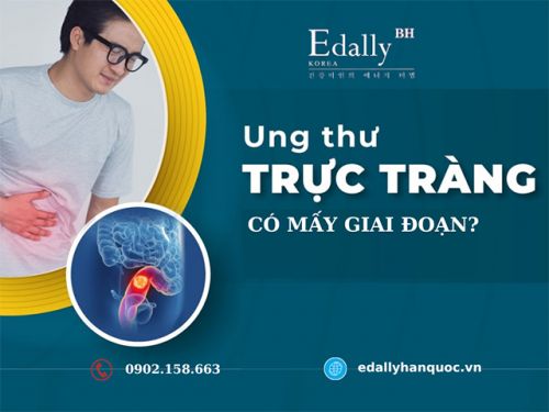 Bệnh Ung Thư Trực Tràng Có Mấy Giai Đoạn?