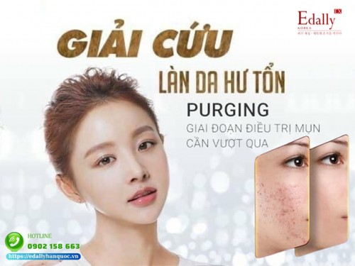 Những Giai Đoạn Điều Trị Mụn Cần Vượt Qua