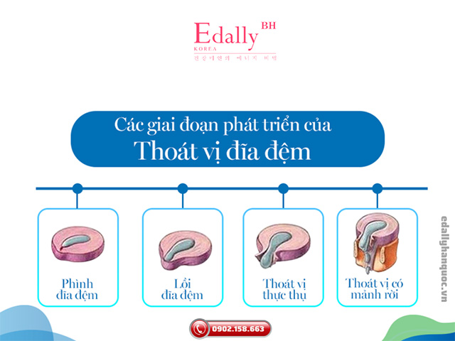 Các giai đoạn phát triển của bệnh thoát vị đĩa đệm