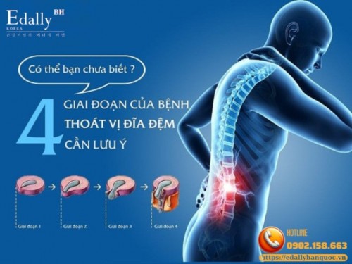 Thoát Vị Đĩa Đệm Và Những Điều Cần Biết
