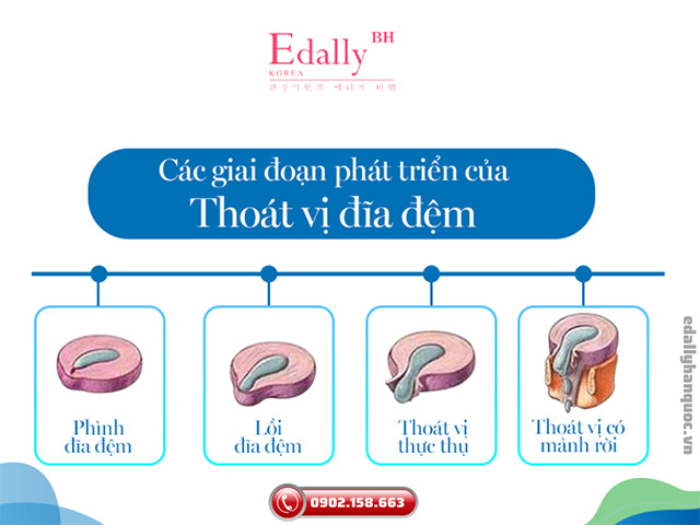 Các giai đoạn tiến triển của bệnh Thoát vị đĩa đệm