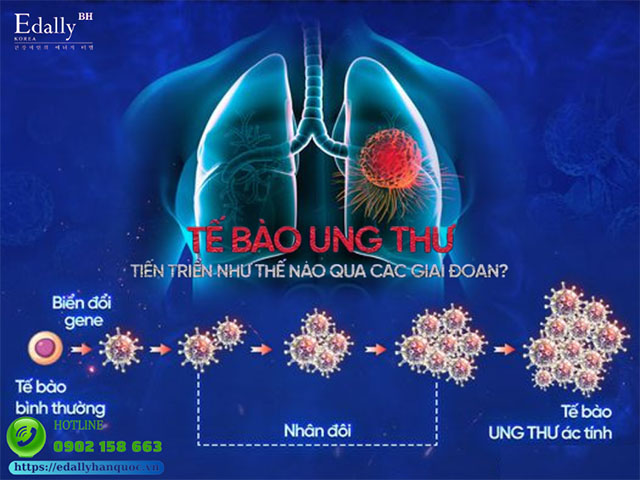 Tế bào ung thư tiến triển qua các giai đoạn như thế nào?