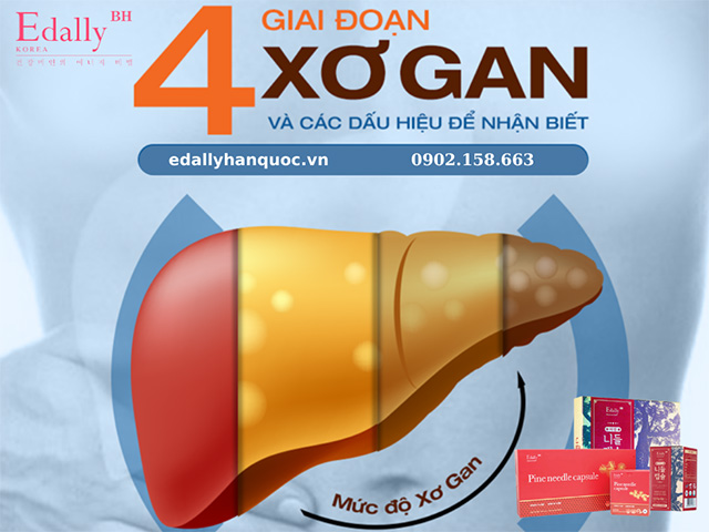 Các Giai Đoạn Xơ Gan