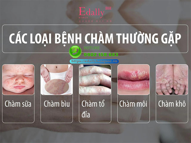 Các loại bệnh chàm