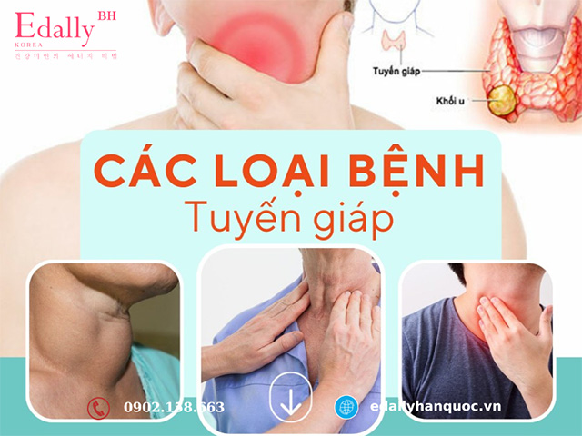 Các bệnh lý thường gặp liên quan đến tuyến giáp