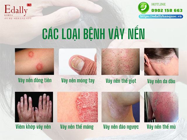 Các loại bệnh vày nến thường gặp