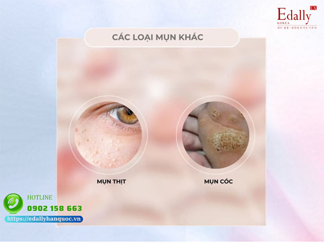 Nhóm các loại mụn khác thường gặp trên da