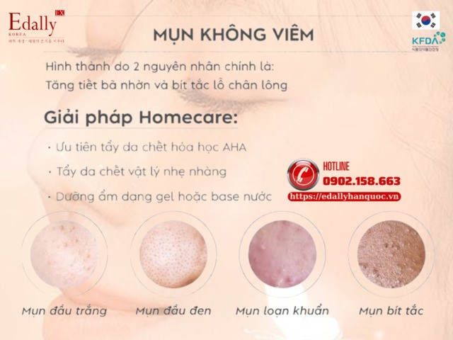 Các loại mụn không viêm và cách chăm sóc hiệu quả