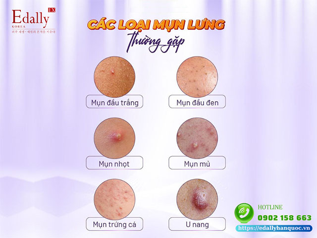 Các loai mụn trứng cá thường gặp ở vùng lưng và vùng ngực