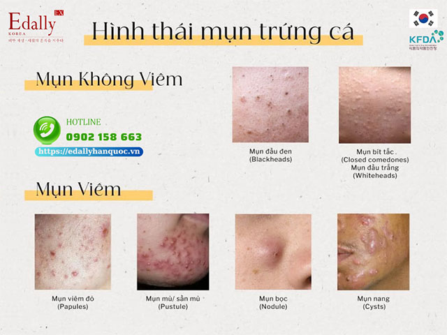 Các loại mụn trứng cá trên nền da yếu