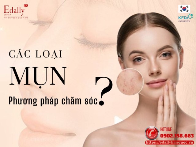 Các loại mụn và phương pháp chăm sóc hiệu quả để mụn không tái lại