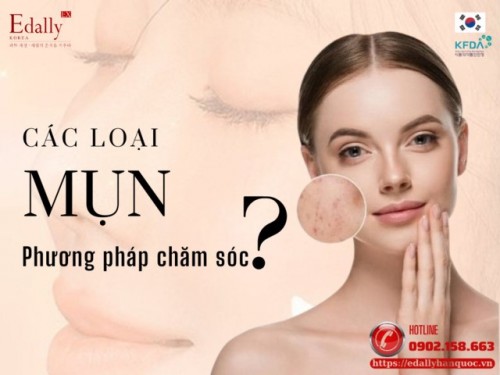 Các Loại Mụn Và Phương Pháp Chăm Sóc Hiệu Quả