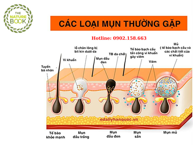 Mụn sần ở tuổi dậy thì