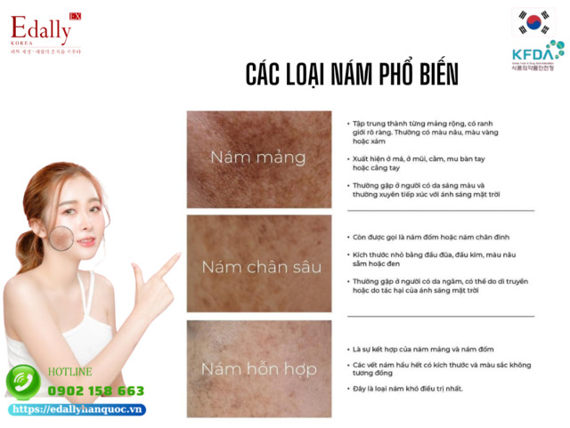 Phân loại nám da