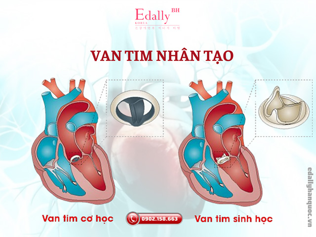 Các loại van tim nhân tạo thông dụng hiện nay