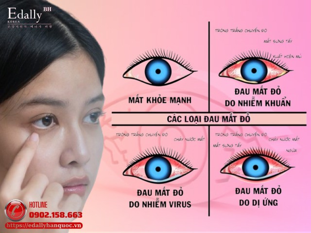 Các loại đau mắt đỏ và dấu hiệu nhận biết Các loại đau mắt đỏ và dấu hiệu nhận biết