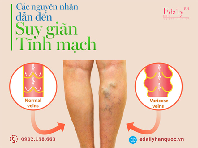 Nguyên nhân khiến bạn mắc bệnh suy giãn tĩnh mạch