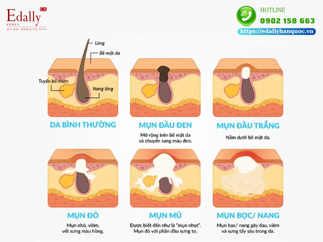 Các thể mụn trứng cá