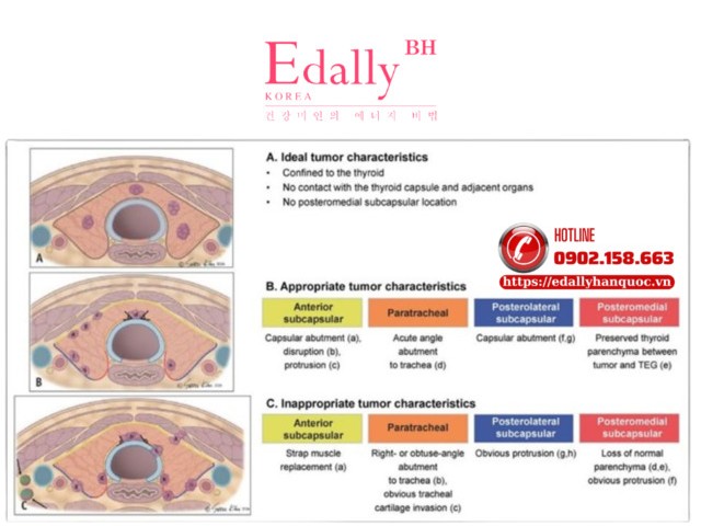 Các tiêu chí đánh giá vi ung thư tuyến giáp thể nhú (PTMC) trên siêu âm trong quá trình theo dõi chủ động (Theo Endocrinology and Metabolism số tháng 6/2025)