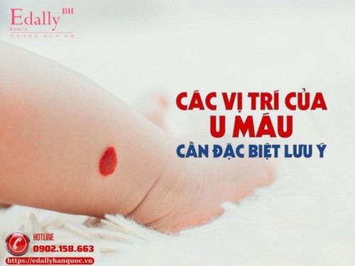 Các Vị Trí Của U Máu Cần Đặc Biệt Lưu Ý