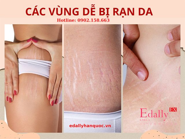 Các vùng dễ bị rạn da