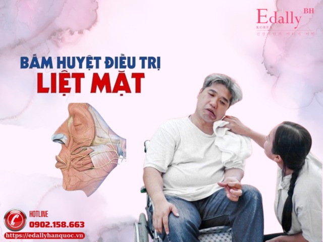 Cách Bấm Huyệt Chữa Méo Miệng (Liệt Mặt)