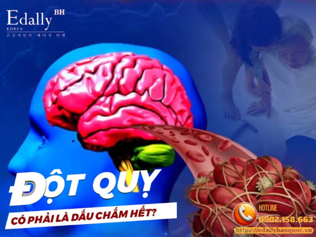 Cách cấp cứu người bị đột quỵ não