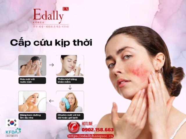 Cách cấp cứu kịp thời khi peel da tại nhà bị bỏng