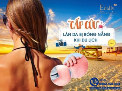 Tips Cấp Cứu Làn Da Bị Bỏng Nắng Khi Đi Du Lịch 