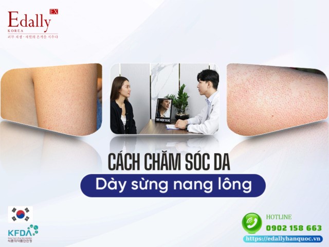 Cách chăm sóc da dày sừng nang lông tại nhà hiệu quả