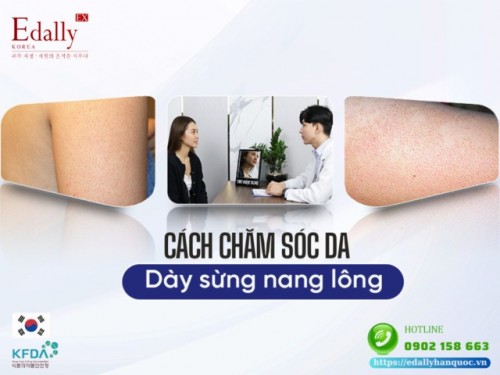 Cách Chăm Sóc Da Dày Sừng Nang Lông Tại Nhà