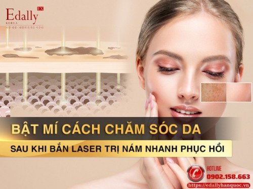 Cách Chăm Sóc Da Sau Điều Trị Nám Bằng Laser