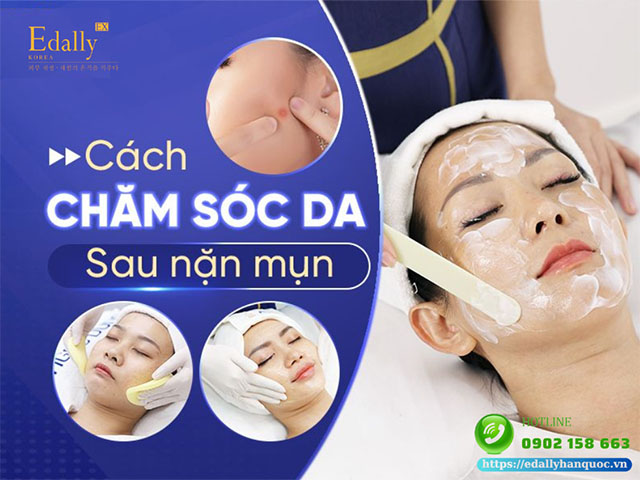 Cách chăm sóc da sau nặn mụn như thế nào cho nhanh lành?