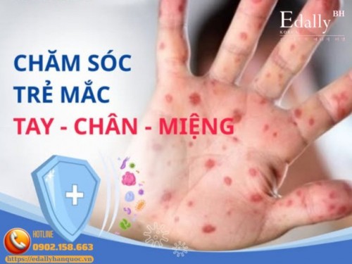 Cách Chăm Sóc Trẻ Bị Mắc Tay - Chân - Miệng 