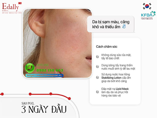 Hướng dẫn cách chăm sóc và phục hồi da nhạy cảm sau peel 3 ngày đầu