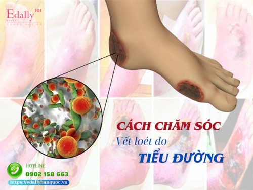 Chăm Sóc Vết Loét Do Bệnh Tiểu Đường Biến Chứng Để Không Phải Cắt Chi