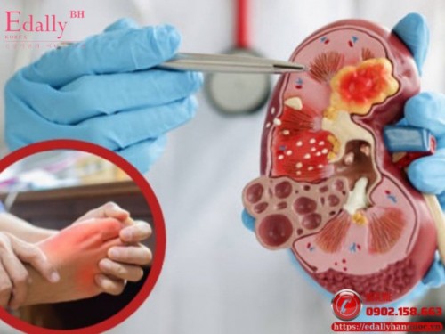 Cách Điều Trị Bệnh Gút Ở Bệnh Nhân Mắc Bệnh Thận Mạn
