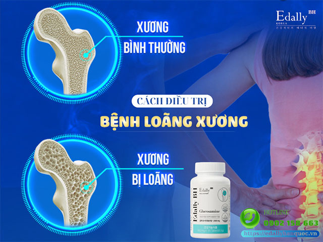 Cách điều trị bệnh loãng xương như thế nào?