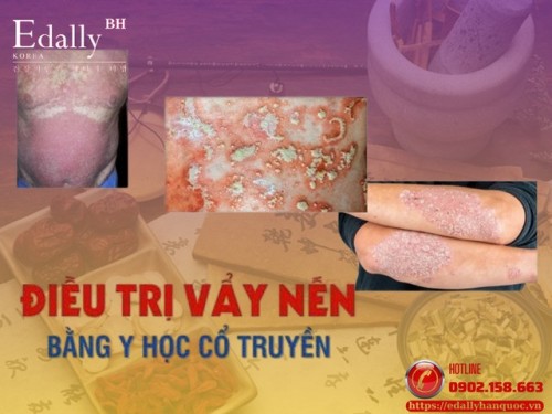 Điều Trị Bệnh Vẩy Nến Bằng Y Học Cổ Truyền
