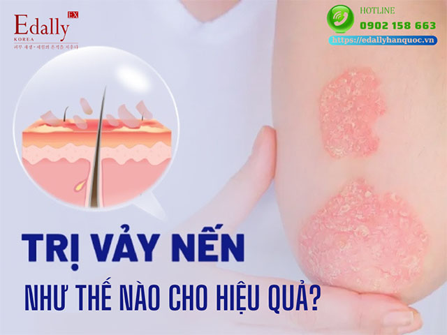 Điều trị bệnh vảy nến như thế nào cho hiệu quả?