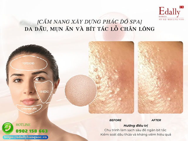 Cách Điều Trị Da Dầu, Mụn Ẩn Và Bít Tắc Lỗ Chân Lông