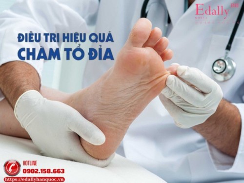 Cách Điều Trị Bệnh Chàm Tổ Đỉa Như Thế Nào Cho An Toàn Và Hiệu Quả?