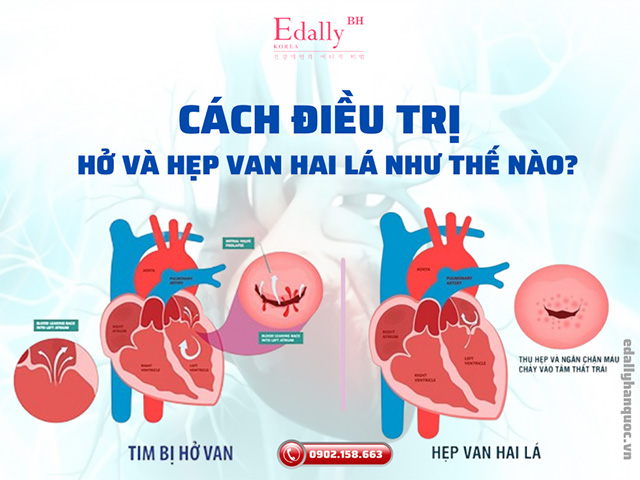 Cách điều trị hở và hẹp van hai lá như thế nào?