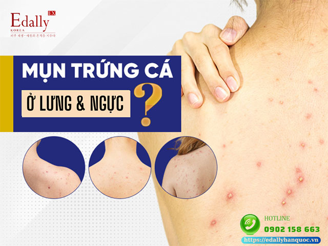 Cách điều trị mụn trứng cá ở vùng lưng, vùng ngực như thế nào