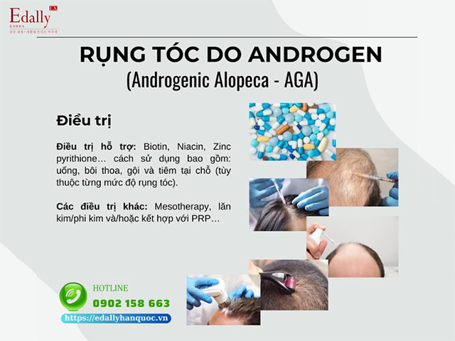 Cách điều trị rụng tóc hói đầu do Androgen