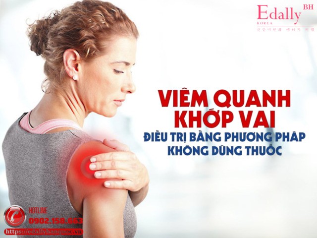 Cách điều trị viêm quanh khớp vai bằng phương pháp không dùng thuốc