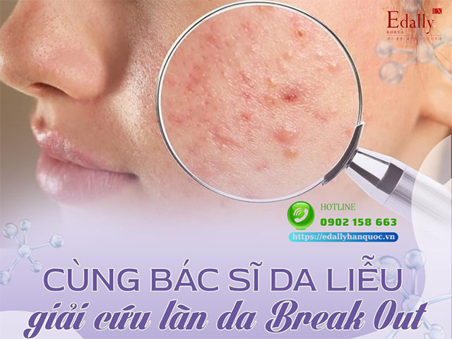 Cùng bác sĩ da liễu giải cứu làn da bị Break out