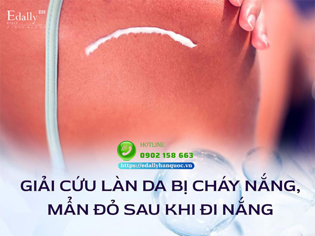 Cách Giải Cứu Làn Da Bị Cháy Nắng, Mẩn Đỏ Sau Khi Đi Nắng