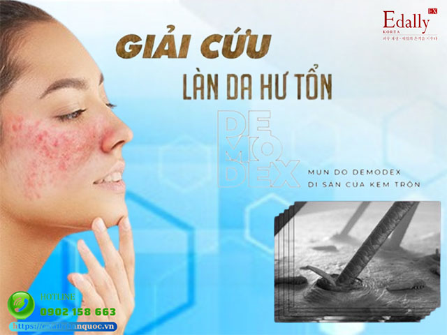 Cách giải cứu làn da nhiễm Demodex - Corticoid như thế nào?